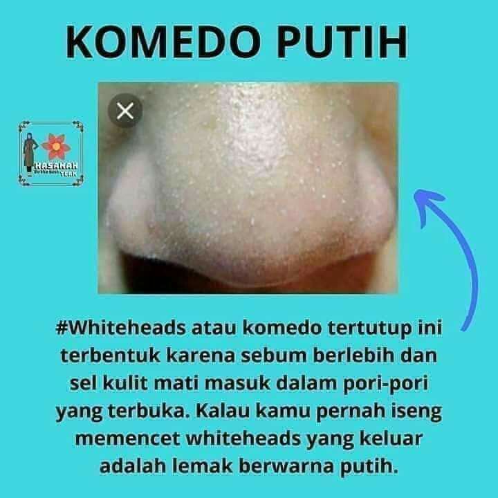 Anda komedoan? Komedo putih ataupun komedo hitam ..rontokin aja pakai Coffee Mask peeling SR12....Semua jenis komedo...mingggaaat...wajah cerah sehat berseri alami..produk SR12 ini aman dan sudah BPOMWa/telegram 👉0821-5799-8873AGEN RESMI SR12 HERBAL SKINCARE BALIKPAPANAnda komedoan? Komedo putih ataupun komedo hitam ..rontokin aja pakai Coffee Mask peeling SR12....Semua jenis komedo...mingggaaat...wajah cerah sehat berseri alami..produk SR12 ini aman dan sudah BPOMWa/telegram 👉0821-5799-8873AGEN RESMI SR12 HERBAL SKINCARE BALIKPAPAN