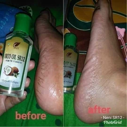 Kaki kering ? tumit pecah-pecah?? terkadang sakit ya ?  Malu juga ya kan...? Kalau udah begini jangan di amplas ya pemirsa ...apalagi di gurinda 😬🤭😅Cukup rutin oles VCO SR12 aja..kalau perlu di minum..kulitmu bakal halus lembut cerah berseri, badan juga jadi seger dan sehat 🤩💪Tu kan  sekali dayung ... dua,  tiga pulau terlampaui 👍🤩🥳Wa/telegram 👉0821-5799-8873Agen Resmi SR12 Herbal Skin care Balikpapan, KalTim