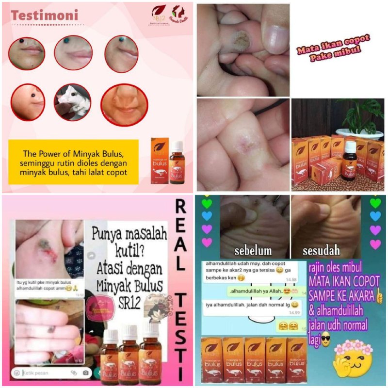 🌿Mau rontokin kutil, mata ikan dan tahi lalat ???Bulusin aja pakai minyak Bulus SR12 🤩🥰 Insya Allah rontok setuntas-tuntasnya🌿Minyak Bulus SR12 ini juga bisa mengatasi berbagai macam penyakit kulit ya diantara nya: gatal2, alergi, panu, eksim, dan sebagainya🌿Solusi jitu yg mau kulit mulus dan sehat dan bebas flek hitam tapi nggak suka pakai Cream-cream'an😬🤩🌿Keunggulan Minyak Bulus SR12:🌸 Tidak Amis🌸 Aroma khas Melati🌸 Asli diambil dari penangkaran Bulus yang dipelihara sengaja untuk di ambil manfaatnya dengan disembelih secara Islam. Jadi InsyaAllah HALAL🌸 Sudah ternotifikasi oleh BPOMWA/Telegram👉0821-5799-8873AGEN RESMI SR12 HERBAL SKINCARE BALIKPAPAN KAL-TIMIntips shopeeku yuks👇shopee*co*id/agenresmisr12Atautokopedia*com/sr12balikpapan_____________Untuk masuk link toko⤴️( * ) ganti  ( . )Bisa pakai voucher free ongkir dan ada pilihan COD juga loh