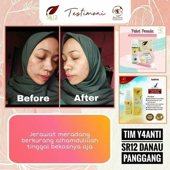 Gak semua jerawat harus dirawat dengan cream.Yang terpenting langkah pertama adalah netralkan dulu kulit wajah ya dear🤩Keluarkan racunnya, putus siklus ketergantungan terhadap kosmetik sebelumnya, matikan jerawat serta netralkan kulit wajah dengan 