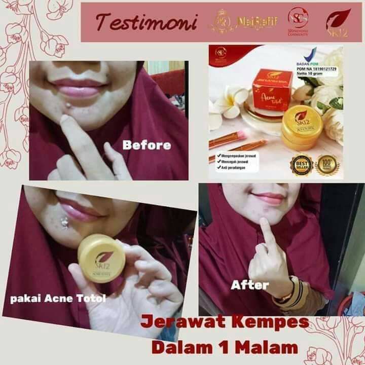 🌿ACNE TOTOL SR12 Setiap kali datang bulan si dia pasti ikutan nongol...Ini lah yg nama nya jerawat hormonPertanda kulit wajah anda sehatKarena kulit yg sehat..masih merespon dengan baik saat ada perubahan hormon dalam diri...Entah itu karena haid,stress atau saat kulit kotor..., Na...kalau jerawat hormon ini muncul..totolin aja dengan ACNE TOTOL SR12 🤩👍totolin nya tiap 3 jam sekali ya,  tepat pada jerawatnya saja ya..dijamin langsung kering ngelupas sendiri tanpa bekas hitam,okkeeyyy😁Wa/telegram 👉0821-5799-8873Agen Resmi SR12 Herbal Skin care Balikpapan, Kal-TimAtau silahkan kunjungi toko online kami di 👇