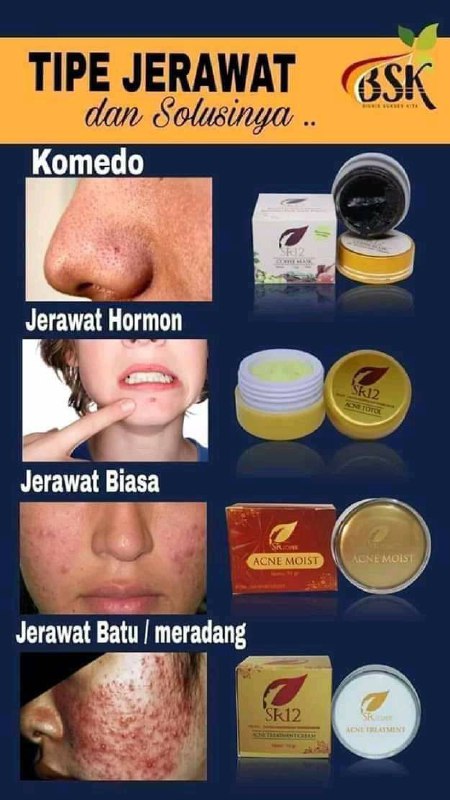 Di SR12 itu Setiap jenis jerawat masing2 punya solusi.sehingga tidak seperti obat jerawat yang lain, terkadang jerawat and kulit wajah tekupas semua hingga tampak putih pucat kayak mayit🤭terkadang pula kulit sekitar sudah bersih putih tapi  jerawat masih meninggalkan bekas merah terkadang bekas hitam2. No no no insyaAllah di SR12 nggak seperti itu ya, di SR12 kulit wajah akan kembali normal seperti sediakala warna asli kulitmu bahkan  lebih sehat cerah alami🥰🤩😎ORDER/KONSULTASI (Free)Wa/telegram 👉0821-5799-8873AGEN RESMI SR12 HERBAL SKINCARE BALIKPAPAN, KAL-TIM