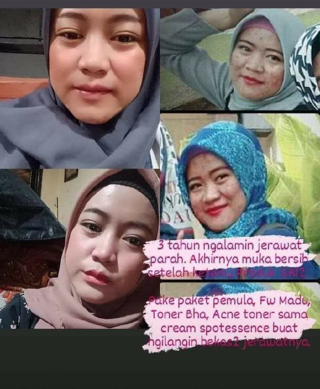 Pasti brasa mimpi ya mbak punya wajah yg bersih bebas jerawat seperti sekarang setelah 3 tahun mengalami jerawat yg parah. Luar biasa kesetiaan nya menggunakan produk SR12Hasil nya pun memuaskan😍Fokus ngobatin/ngilangin jerawatnya dulu dg rutin pakai 🌸paket pemula jerawat SR12, 🌸Acne toner SR12🌸Toner BHA SR12 🌸Facial wash madu SR12setelah jerawatnya sembuh baru  fokus ngilangin bekas jerawatnya pake:🌸 Cream spot essence SR12 MasyaAllah..luarrtt biazzzzaaaa🤩😎👍READY SEMUA YA....Silah order dan konsultasi (free)WA/telegram👉0821-5799-8873AGEN RESMI SR12 HERBAL SKINCARE BALIKPAPAN KAL-TIMMampir ke shopeeku yuks 👇shopee.co.id/agenresmisr12Atautokopedia.com/sr12balikpapan