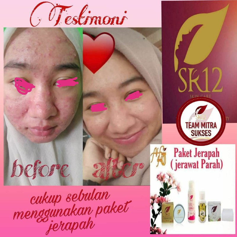 Untuk order/konsultasi Paket Jerapah (Jerawat parah),Segera hubungi: Wa/telegram👉0821-5799-8873AGEN RESMI SR12 HERBAL SKINCARE BALIKPAPAN