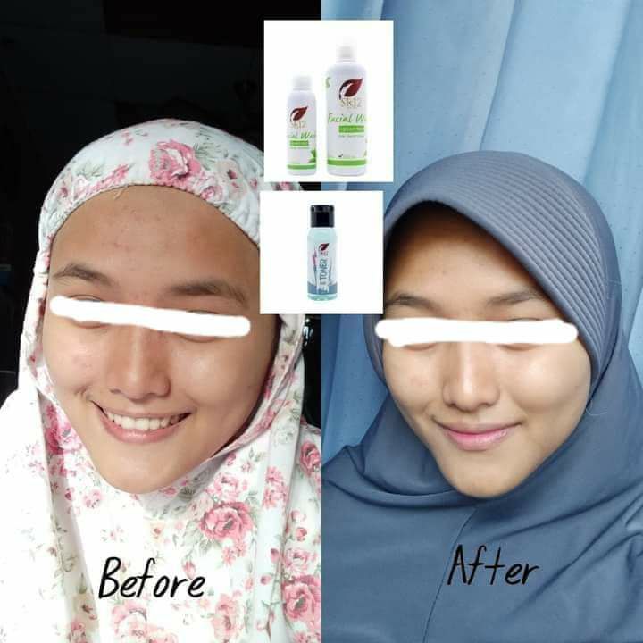 🌿🌸Duet Toner BHA SR12 dan Facial wash green tea SR12, jerawat bruntus hilang, wajahpun semakin cerah alami, bening semriwing🤩Facial wash green tea memang Special buat kulit berminyak dan berjerawat🌸🌿Kemudian Toner BHA SR12 beraksi lagi, kali ini duet bareng sabun Beras SR12Sabun beras cocok untuk kulit berminyak sensitif dan berjerawatReady🌿Toner BHA🌿Rice soap🌿 Facial wash green tea (berminyak-jerawat)🌿 Facial wash green tea(Kering-jerawat)👆Lihatlah wajah SR12, cerah alami kan? Bersih maksimal sampai ke warna asalnya, tidak putih pucat licin melene iya kan? tidak tekupas merah2 iya kan ? Wajah Herbal itu emang adem ngeliatnya🥰yuk segera di order🎉konsultasi (free)WA/telegram👉0821-5799-8873AGEN RESMI SR12 HERBAL SKINCARE BALIKPAPAN KAL-TIMshopee*co*id/agenresmisr12Atautokopedia*com/sr12balikpapan________Utk masuk link toko⤴️ (*) ganti (.)Jangan lewatkan 12.12 di shopee 🥳 voucher/kupon free ongkir Lo, bisa COD juga lo,Kalau di tokpedku bisa pilih pengiriman instan via GO SEND 🎉🎉🌿🌸Duet Toner BHA SR12 dan Facial wash green tea SR12, jerawat bruntus hilang, wajahpun semakin cerah alami, bening semriwing🤩Facial wash green tea memang Special buat kulit berminyak dan berjerawat🌸🌿Kemudian Toner BHA SR12 beraksi lagi, kali ini duet bareng sabun Beras SR12Sabun beras cocok untuk kulit berminyak sensitif dan berjerawatReady🌿Toner BHA🌿Rice soap🌿 Facial wash green tea (berminyak-jerawat)🌿 Facial wash green tea(Kering-jerawat)👆Lihatlah wajah SR12, cerah alami kan? Bersih maksimal sampai ke warna asalnya, tidak putih pucat licin melene iya kan? tidak tekupas merah2 iya kan ? Wajah Herbal itu emang adem ngeliatnya🥰yuk segera di order🎉konsultasi (free)WA/telegram👉0821-5799-8873AGEN RESMI SR12 HERBAL SKINCARE BALIKPAPAN KAL-TIMshopee*co*id/agenresmisr12Atautokopedia*com/sr12balikpapan________Utk masuk link toko⤴️ (*) ganti (.)Jangan lewatkan 12.12 di shopee 🥳 voucher/kupon free ongkir Lo, bisa COD juga lo,Kalau di tokpedku bisa pilih pengiriman instan via GO SEND 🎉🎉