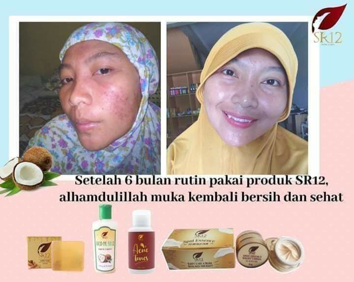 Kalau kulit kita sehat cerah Alami,  glowing terawat itu ya...semurah apapun pakaian yang melekat di badan kita akan terlihat mahal dan indah😁🥰. Begitu juga sebaliknya, semahal apapun pakaian dan aksesoris yang melekat di badanmu, kalau kulitmu kusam tidak terawat maka tetap aja terlihat kumuh bin kucel, tidak singkron...😣🙄😅.Jadi sgra perawatan ya ...apalagi yang punya duit banyak di anugerahi rezeki melimpah ruah jangan pelit terhadap dirimu sendiri🤗😅yang masih blum di anugerah rezeki lebih, di SR12 ada kok sabun2 dan paket hemat yang cukup terjangkau harganya, yuk sayangi dan rawat kulitmu dengan yg alami dan herbal Yaitu SR12 HERBAL SKINCARE. Yang sudah jelas aman BP0M,  cantik sehat terawat tanpa rasa khawatir bersama SR12.Order/Konsultasi (free):Wa/telegram 👉0821-5799-8873AGEN RESMI SR12 HERBAL SKINCARE BALIKPAPAN, KAL-TIMAtau silahkan kunjungi dan belanja di toko online kami di 👇